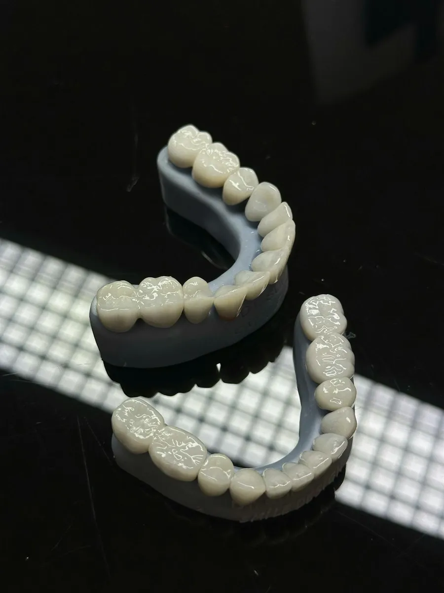 Porcelain veneer shells crafted at a dental laboratory for smile transformation at Taki Dent, Turkey